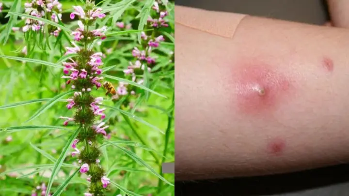 Bài thuốc trị mụn nhọt, mưng mủ