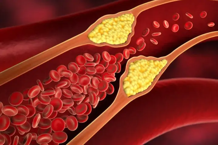 Giảm chất béo, cholesterol Giảm chất béo, cholesterol