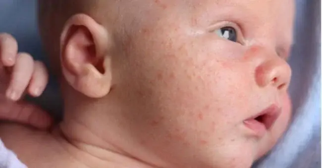 Tổng Quan Về Bệnh Mụn Kê Ở Trẻ