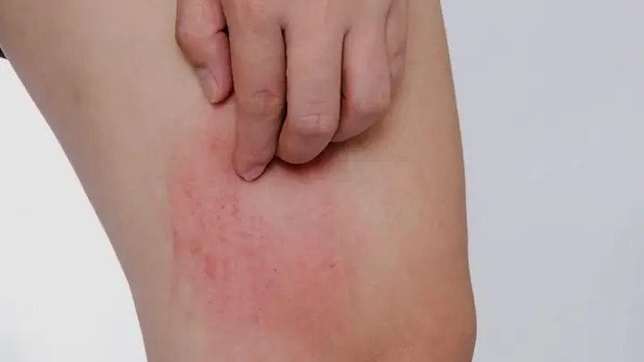 Những tác dụng phụ có thể gặp, tương tác có thể gặp khi sử dụng bồ công anh Những tác dụng phụ có thể gặp, tương tác có thể gặp khi sử dụng bồ công anh