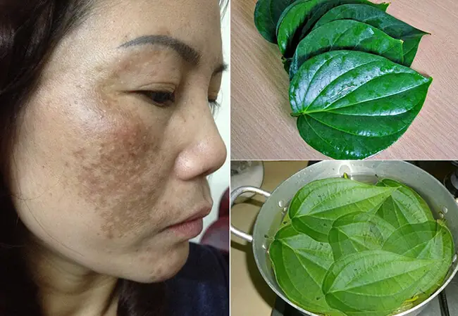 Đắp lá trầu không chữa nám da, lợi hay hại? - Ảnh 2. Đắp lá trầu không chữa nám da, lợi hay hại? - Ảnh 2.
