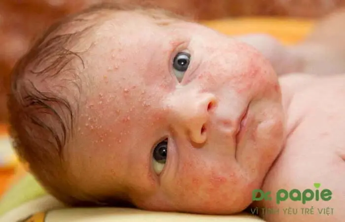 4.1. Chỉ áp dụng trị rôm sảy bằng kinh giới để trị rôm sảy nhẹ