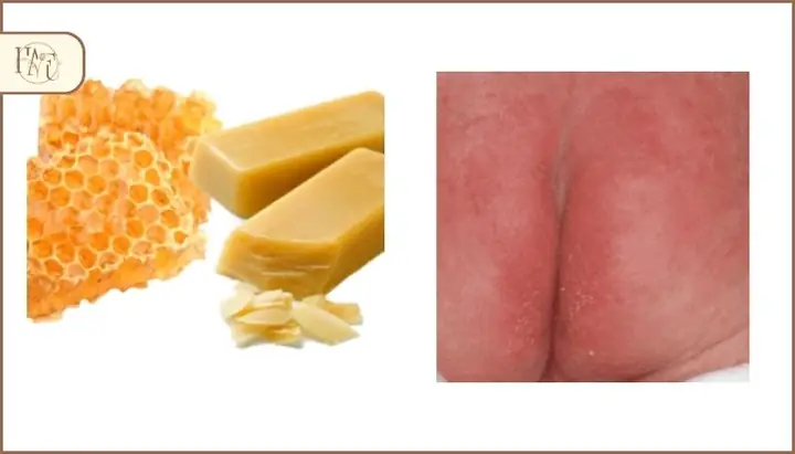 2.1. Trị Hăm Tã Ở Trẻ Sơ Sinh, Trẻ Nhỏ