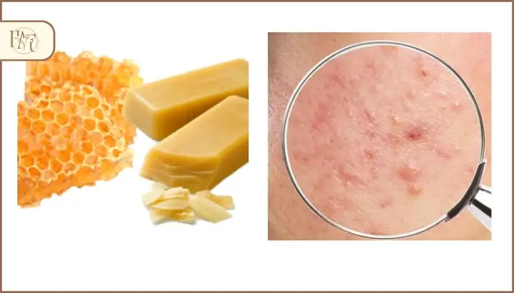 2.4. Ngừa mụn, giảm mụn